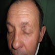4. Базально-клітинний рак шкіри (базаліома) ерозивно-вузлувата форма